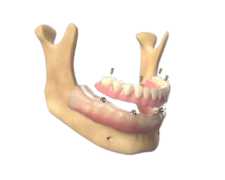 contextsignatureimagedenture-removebg-preview 1