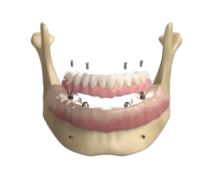 shotimagedenture04-removebg-preview 1